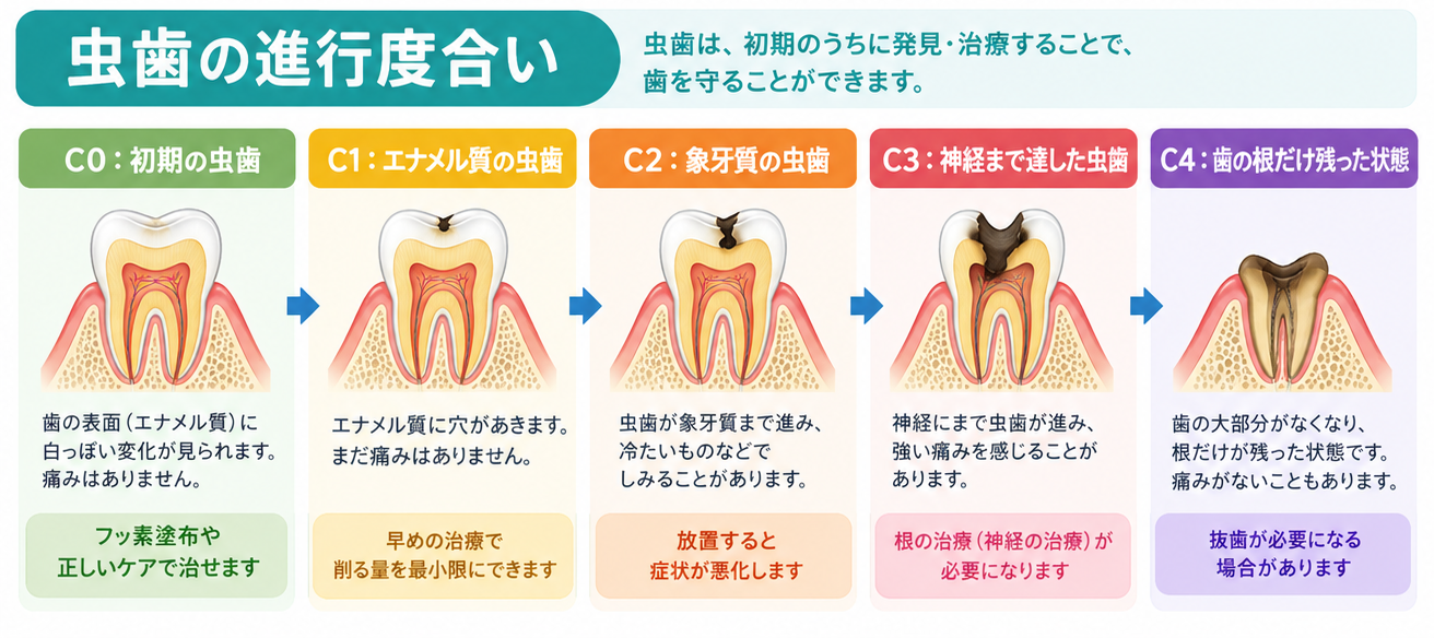 虫歯の進行度合い C0からC4までの図解